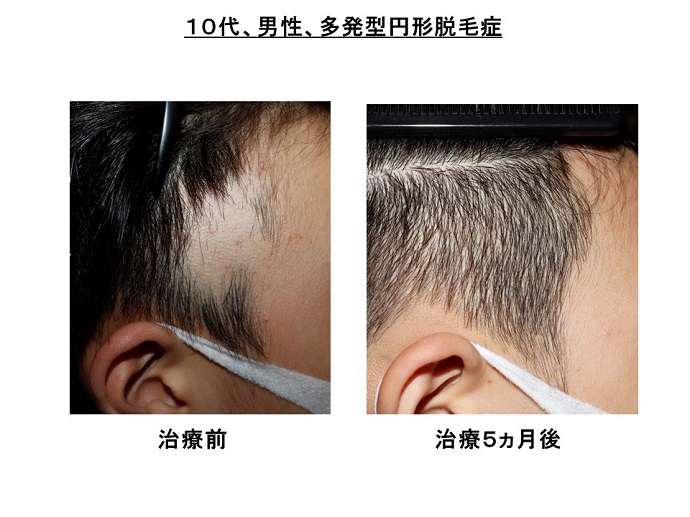 円形脱毛症　病院